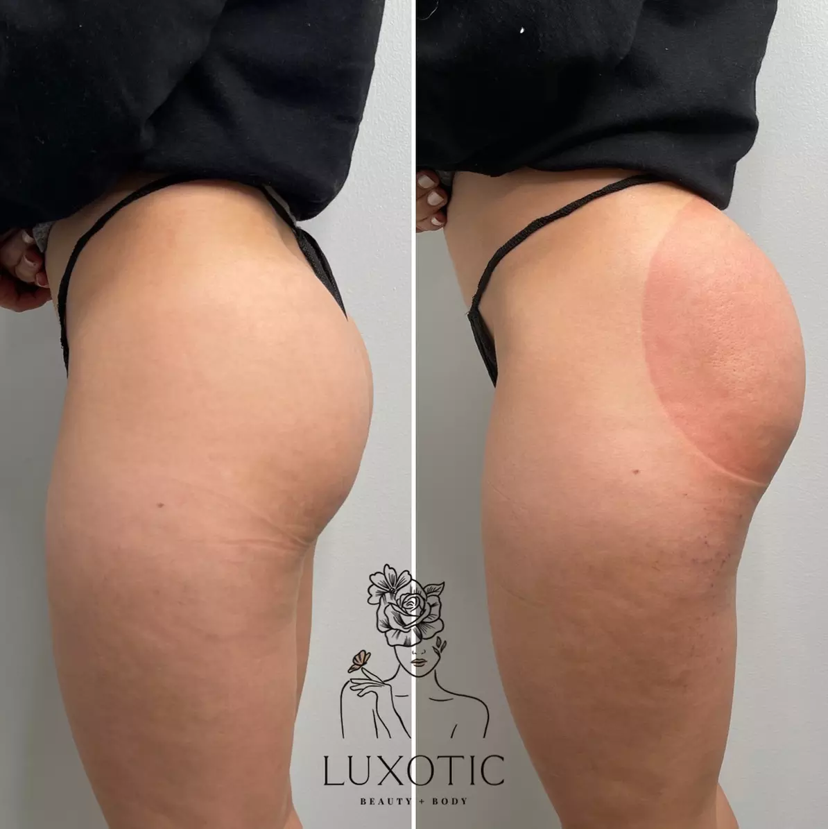 Experience Luxotic Beauty+Body's non-surgical butt lift with mega cups and thermal treatment, up to 30% off - Primary Image
