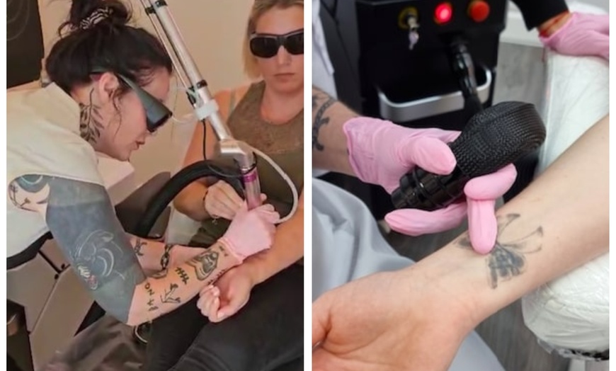 Image 3: Up to 60% Off on Tattoo Removal at Hot Mess