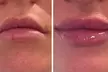 Half (0.55mL) or Full Syringe  (1mL) Lip Filler-Limited Time Deposit at Suite Novella Aesthetics (Up to 78% Off) - Second Medium