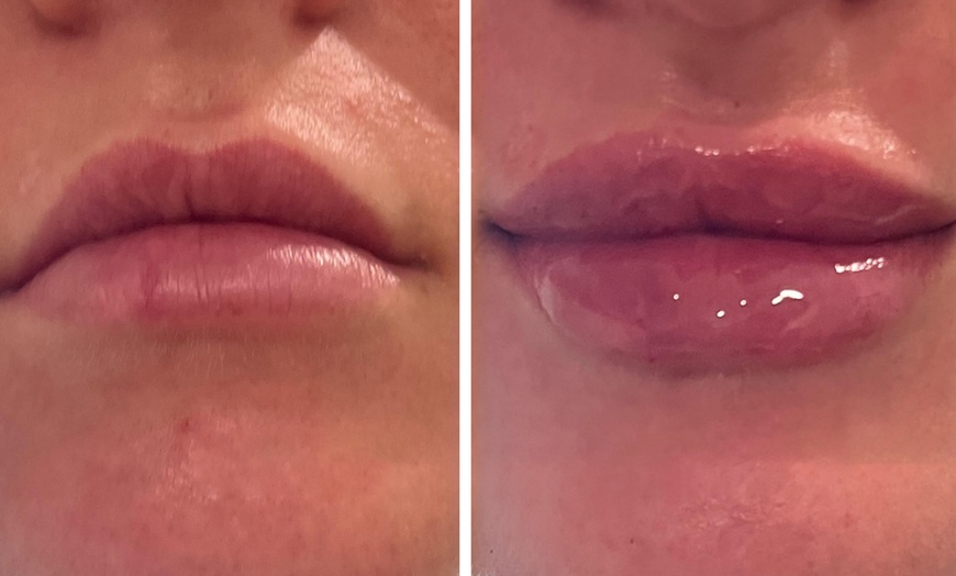 Image 3: Half (0.55mL) or Full Syringe  (1mL) Lip Filler - Limited Time Deposit