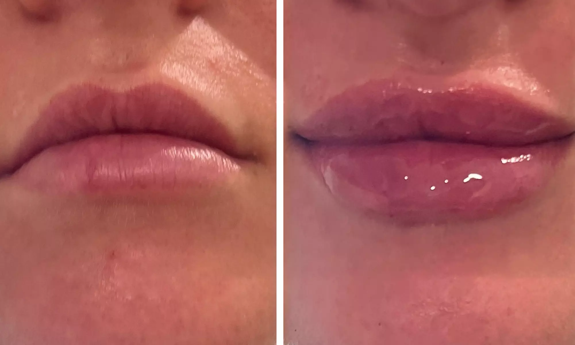 Half (0.55mL) or Full Syringe  (1mL) Lip Filler - Limited Time Deposit