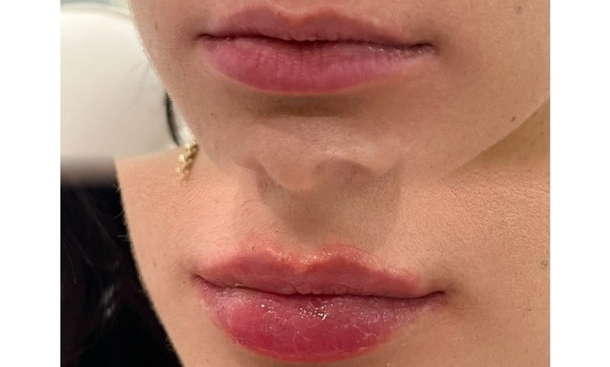 Image 7: One Syringe of Revanesse Versa for Lips or Face at Milan Medical