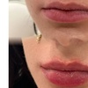 Image 7: One Syringe of Revanesse Versa for Lips or Face at Milan Medical