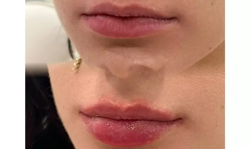 One Syringe of Revanesse Versa for Lips or Face at Milan Medical