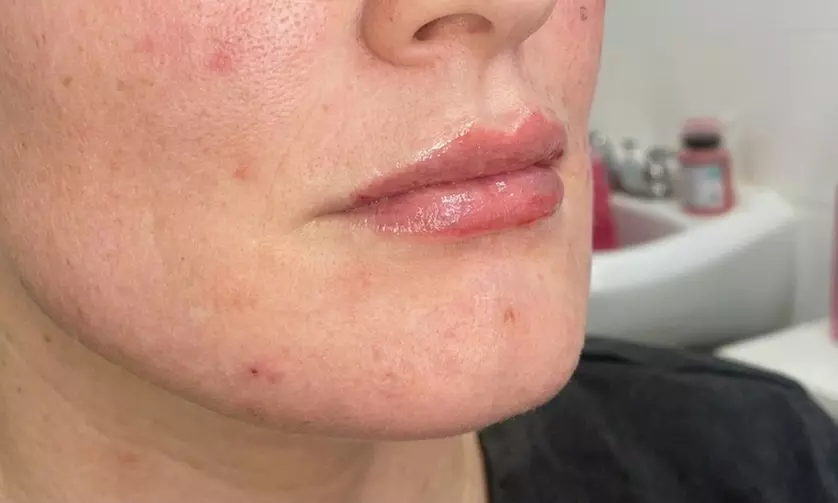 Juvederm Volbella Lip Filler Treatments with 0.5 mL or 1.0 mL Options