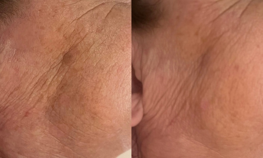 Image 4: Radio Frequency Skin Tightening Treatment