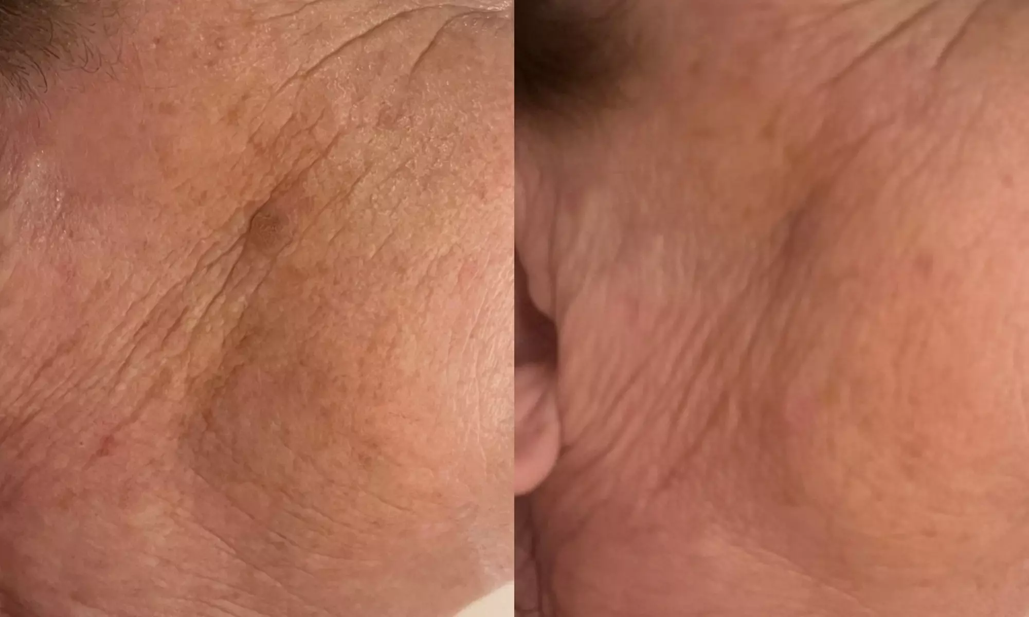 Radio Frequency Skin Tightening Treatment