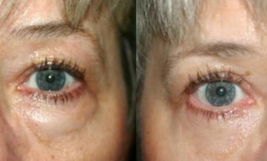 Image 3: Reveal Brighter, Younger-Looking Eyes with Eyelid Surgery
