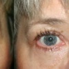 Image 3: Reveal Brighter, Younger-Looking Eyes with Eyelid Surgery