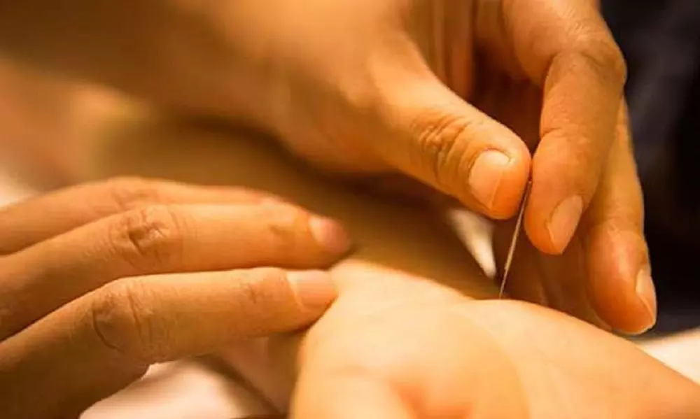 One or Two Acupuncture Sessions at Complete Balance Neuro Acupuncture Internship Clinic (Up to 82% Off) - Primary Image