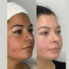 Image 3: Choice of One or Two Microdermabrasion or IPL Photo Facials