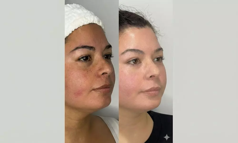 Choice of One or Two Microdermabrasion or IPL Photo Facials