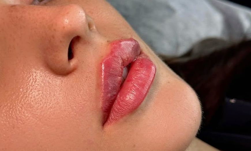 Image 1: Plump, Smooth & Glow: 0.5, 1 or 2 ml Dermal Filler with Consultation