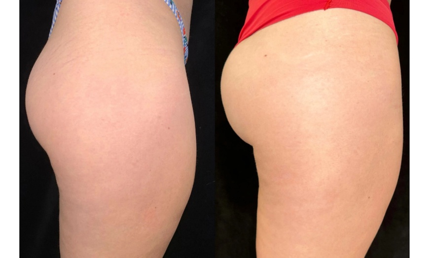 Image 17: Tone with Five Sessions of Body Sculpting - Small or Large Area