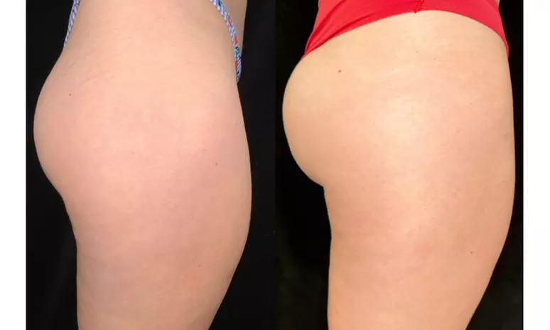 Tone with Five Sessions of Body Sculpting - Small or Large Area