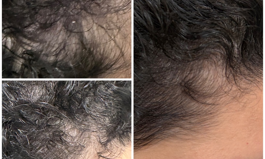 Image 9: Dermclar Method Hair Loss prevention and Neck Massage