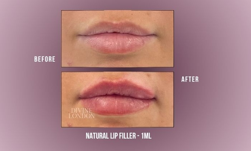 Image 3: Up to 71% Off on Injection - Dermal Filler at Divine Aesthetics Clinic London
