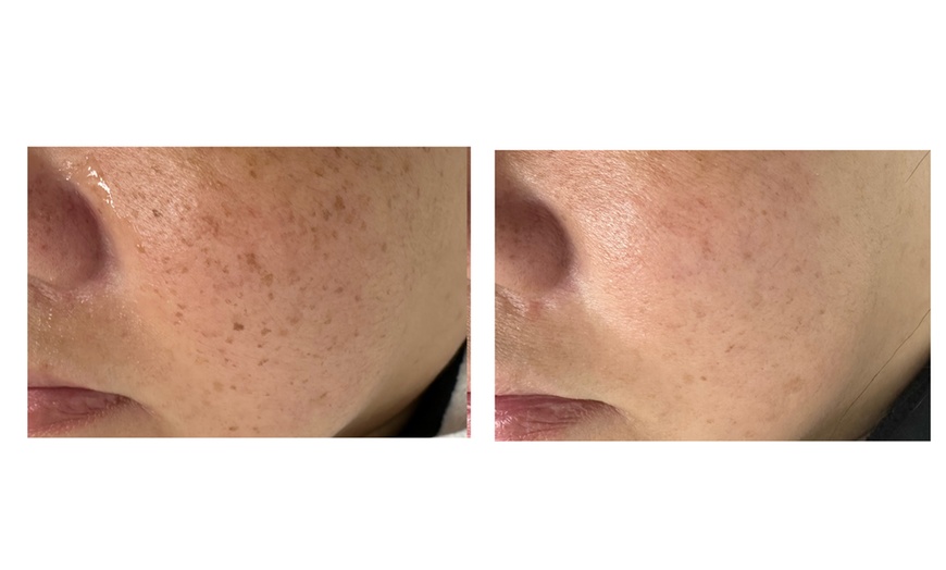 Image 2: Up to 49% Off on IPL-Intense Pulse Light Therapy at Skin Care New York