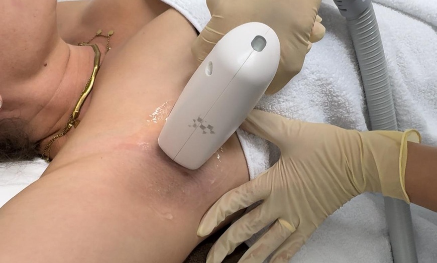 Image 2: 3x oder 5x Laser Haarentfernung an kleiner Zone für Frauen oder Männer