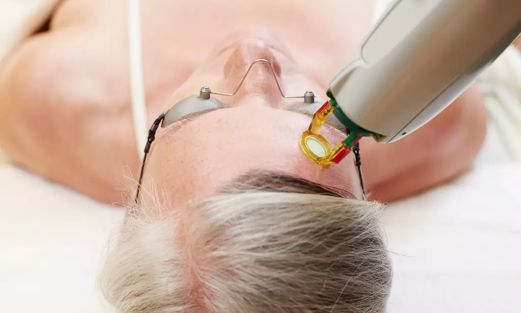 Radiofrequency Microneedling Skin Tightening & Rejuvenation Treatment