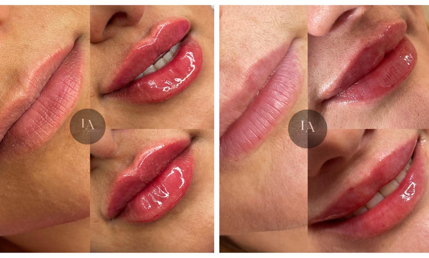 Image 3: Enhance Your Lips with 1.1ml Filler and Expert Consultation