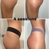 Image 5: Get Lifted with One, Two, or Three 40-Minute Non-Surgical Butt Lifts 