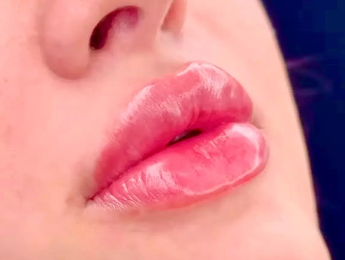 Bis zu 63% Rabatt auf den Injektionsbehandlung – Hyaloronsäure bei SoFi Aesthetik - Primary Image