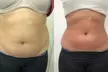 Transform Your Body with Golden Skin's One, Four, or Eight Ultrasonic Cavitation Sessions (Up to 55% Off) - Second Medium