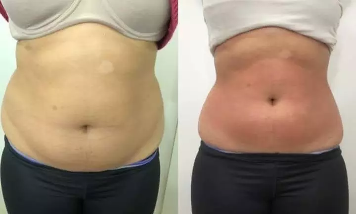 One, Four, or Eight Ultrasonic Cavitation Body Contouring Sessions