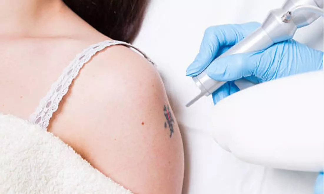 5 o 10 sesiones de eliminación de tatuajes