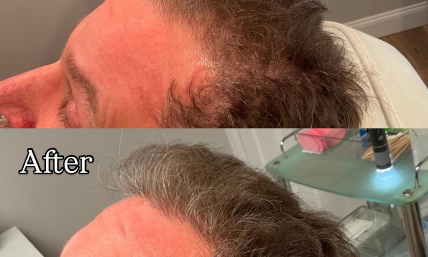 Image 6: Revitalize Thinning Hair w/ Needle-Free Alma TED Sessions