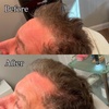 Image 6: Revitalize Thinning Hair w/ Needle-Free Alma TED Sessions