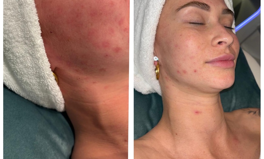 Image 2: Gesichtsbehandlung mit Microneedling / Augenbrauenkorrektur – 1 Person