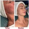 Image 2: Gesichtsbehandlung mit Microneedling / Augenbrauenkorrektur – 1 Person