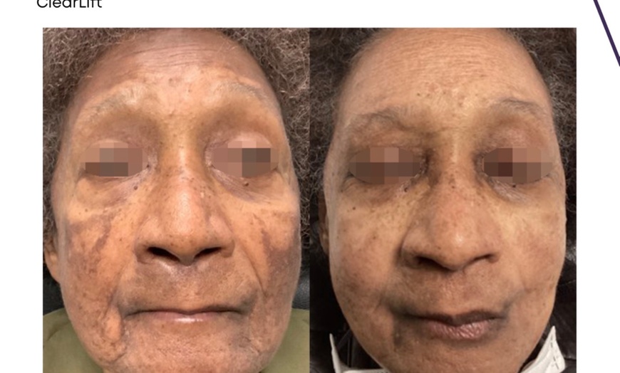 Image 5: ClearLift Laser Session: Face or Face & Neck Rejuvenation