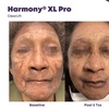 Image 5: ClearLift Laser Session: Face or Face & Neck Rejuvenation