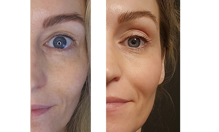 Image 5: Microneedling für Gesicht, opt. inkl. Hals oder SQT BiONeedling