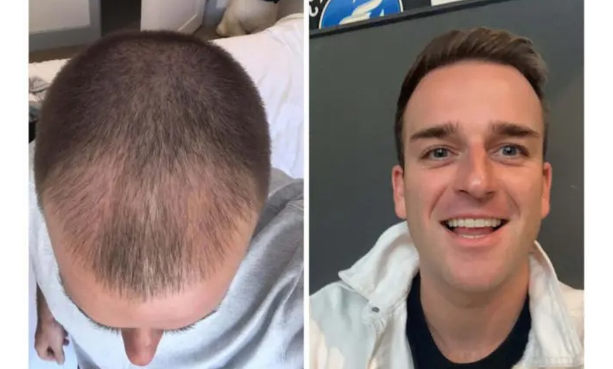 Image 4: Natural-Looking Hair Restoration with Up to 3000-Graft FUE Transplant