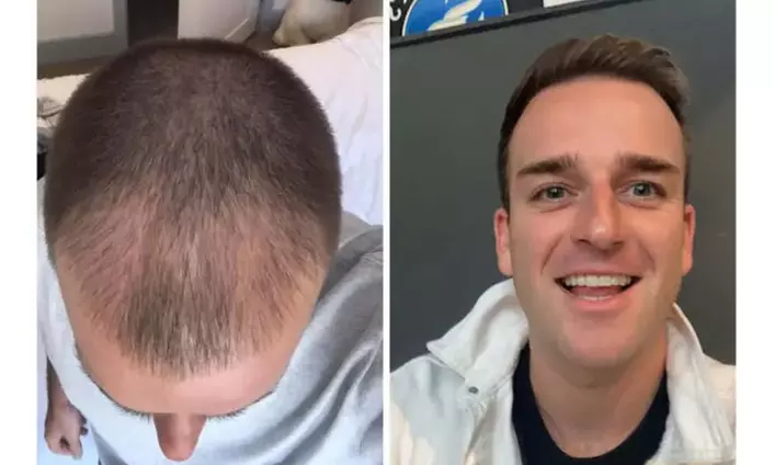 Natural-Looking Hair Restoration with Up to 3000-Graft FUE Transplant