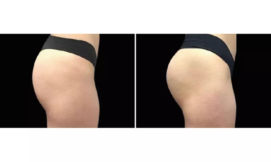 Up to 56% Off on Electrical Muscle Stimulation at TS3 Hair Salon And Spa