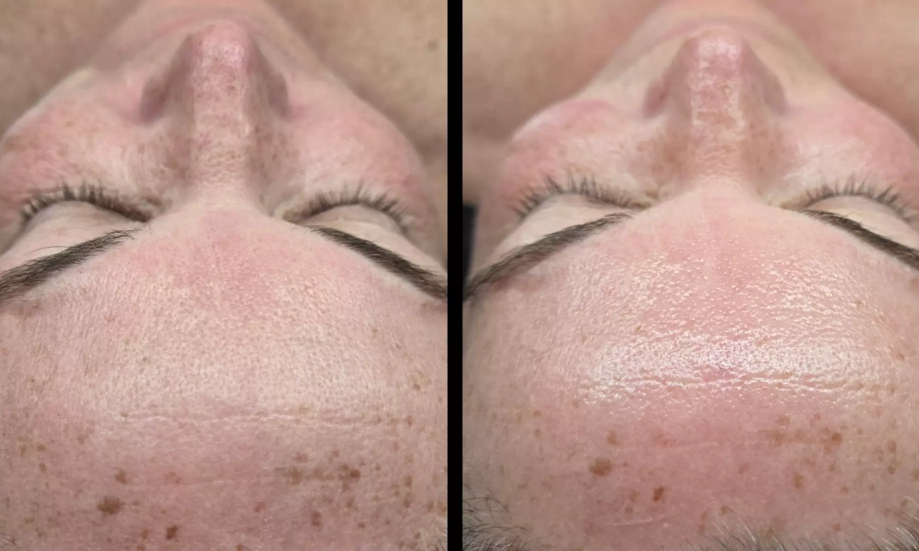 Get Cica Rescue- Korean/ Radiant Cascade Facials, Sea Sponge Peels+ Facial (Up to 76% Off) - Second Medium