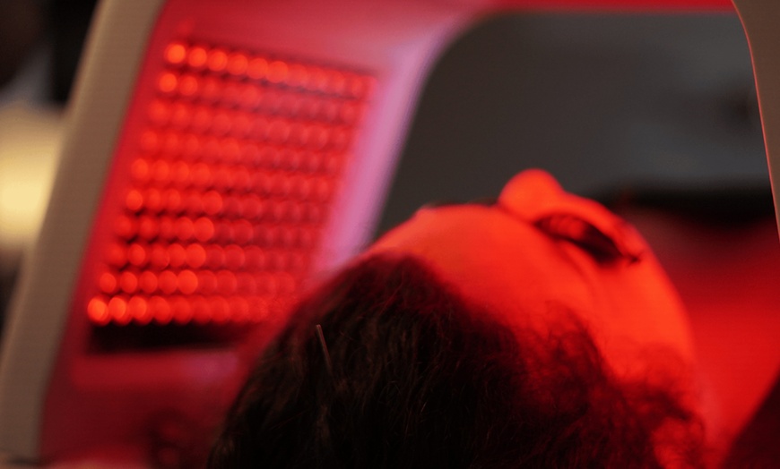 Image 5: Acupuncture, Facial Acupuncture & Cupping for Wellness & Relaxation