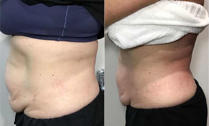 Image 5: Transform Your Body with T-Shape 2 Body Contouring Intro Session