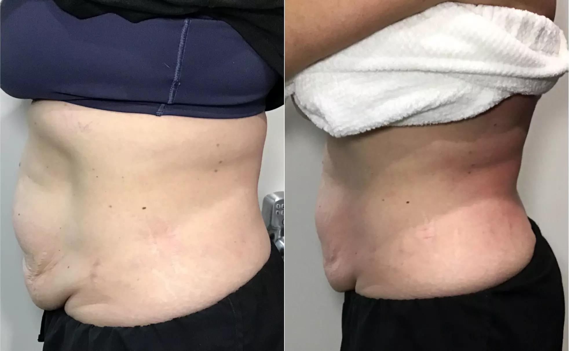 Transform Your Body with T-Shape 2 Body Contouring Intro Session at Blessed Beauty Boutique (Up to 56% Off) - Second Medium