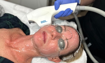 One IPL Treatment (Broad Band Light) with Visia Skincare Analysis, Restrictions Apply - Flower Mound Plastic Surgery & Aesthetic Spa
