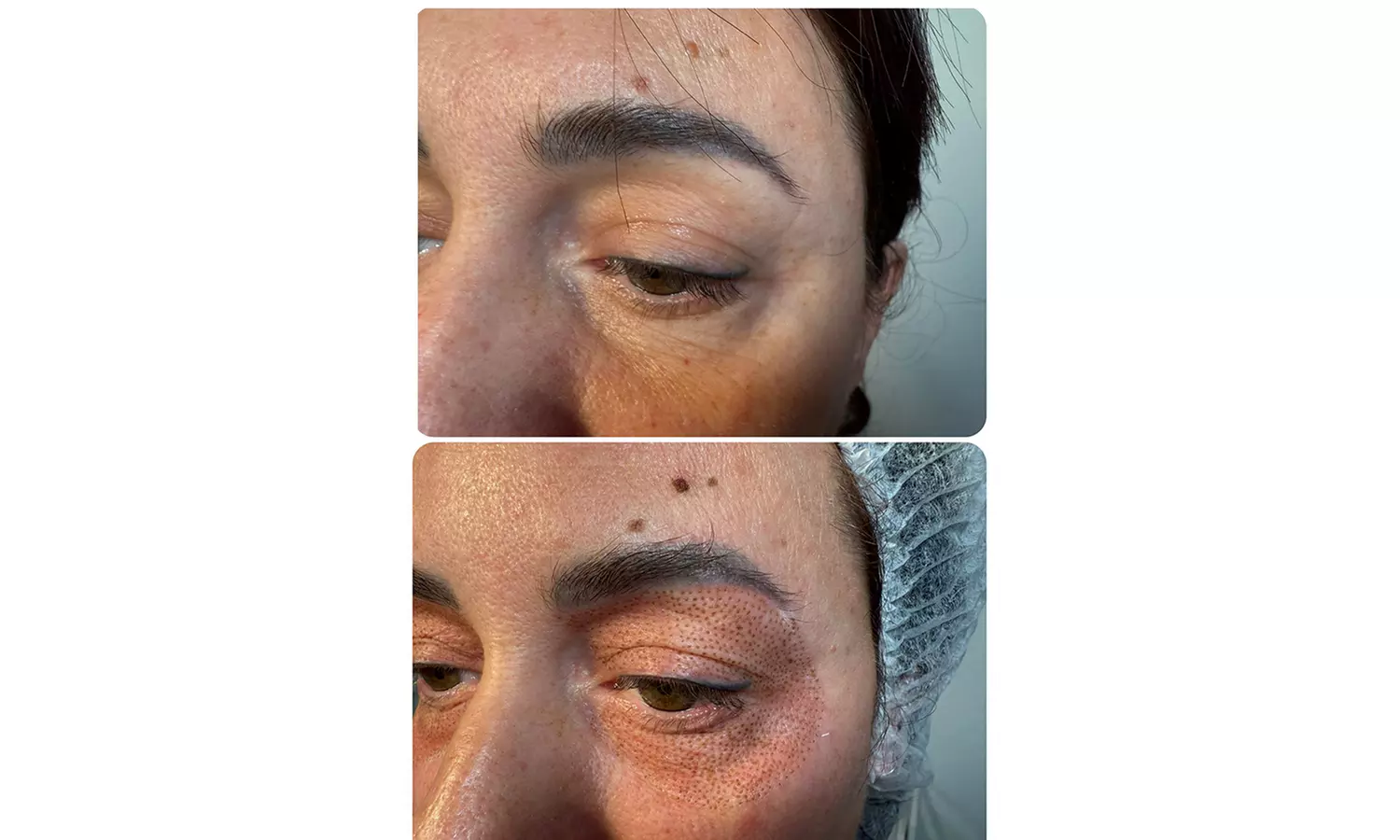 Plasma pen facial no quirúrgico para manchas y zona periocular