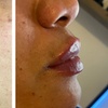 Image 3: Up to 50% Off on Injection - Dermal Filler at Clear skin 33