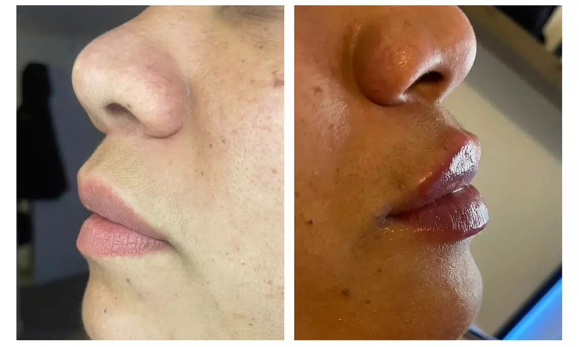 Up to 50% Off on Injection - Dermal Filler at Clear skin 33