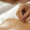 Image 2: Acupuncture, Electroacupuncture at Aquarius Beauty Spa - Up to 58% Off