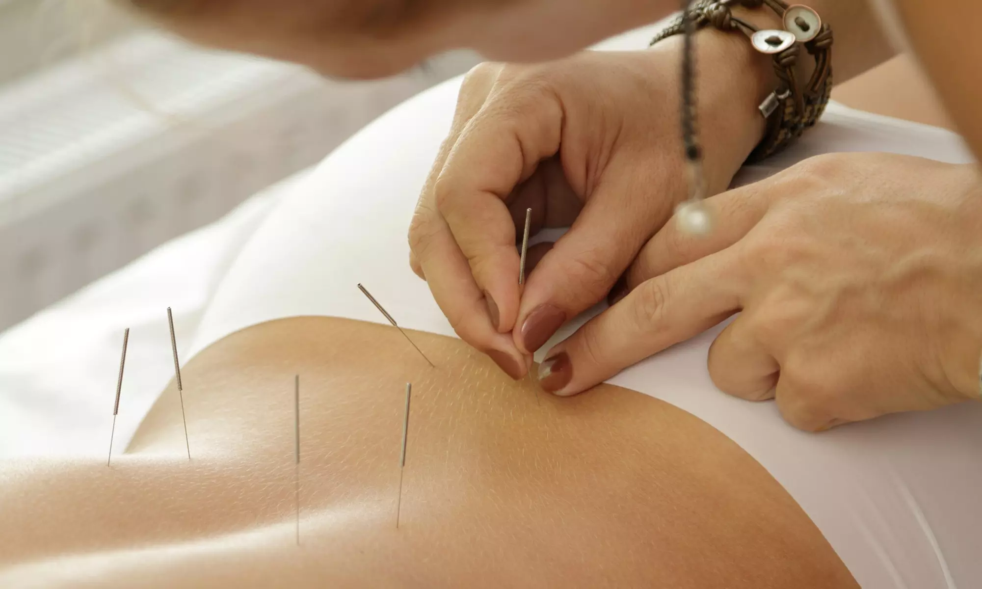 Acupuncture, Electroacupuncture at Aquarius Beauty Spa - Up to 58% Off